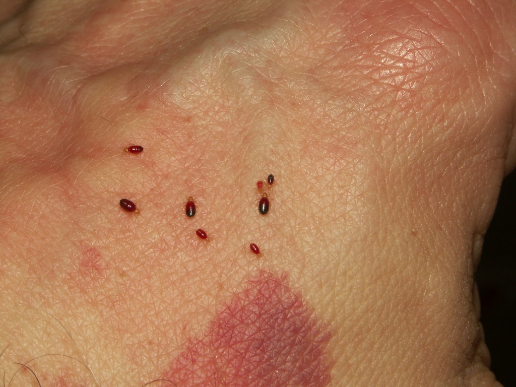 bed bug bites