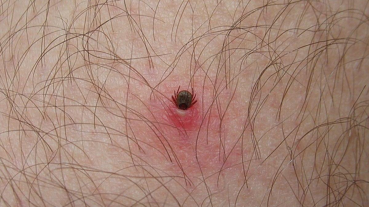 Ticks on Humans, ticks