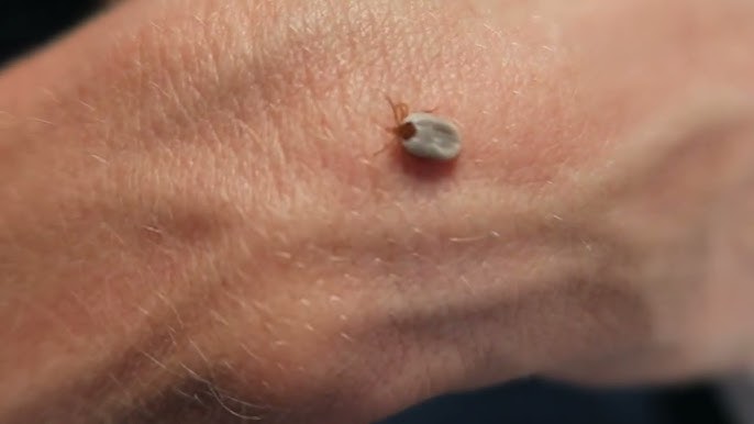 ticks on human hand