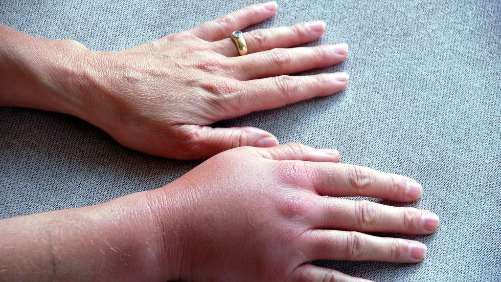 Swollen hands due to Yellow jacket sting