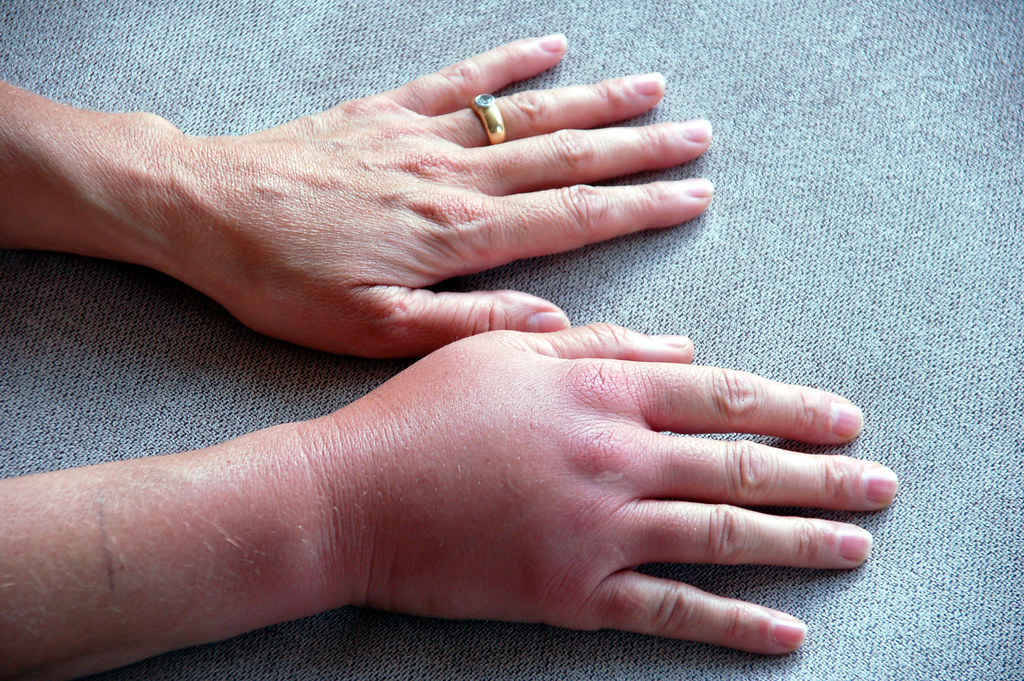 Swollen hands due to Yellow jacket sting