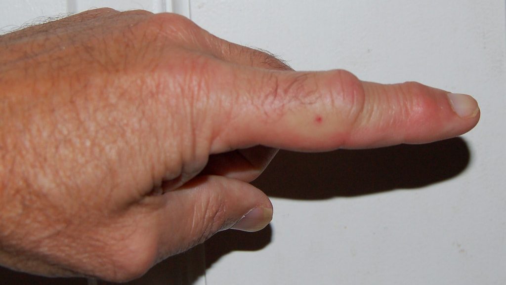 wasp sting symptoms