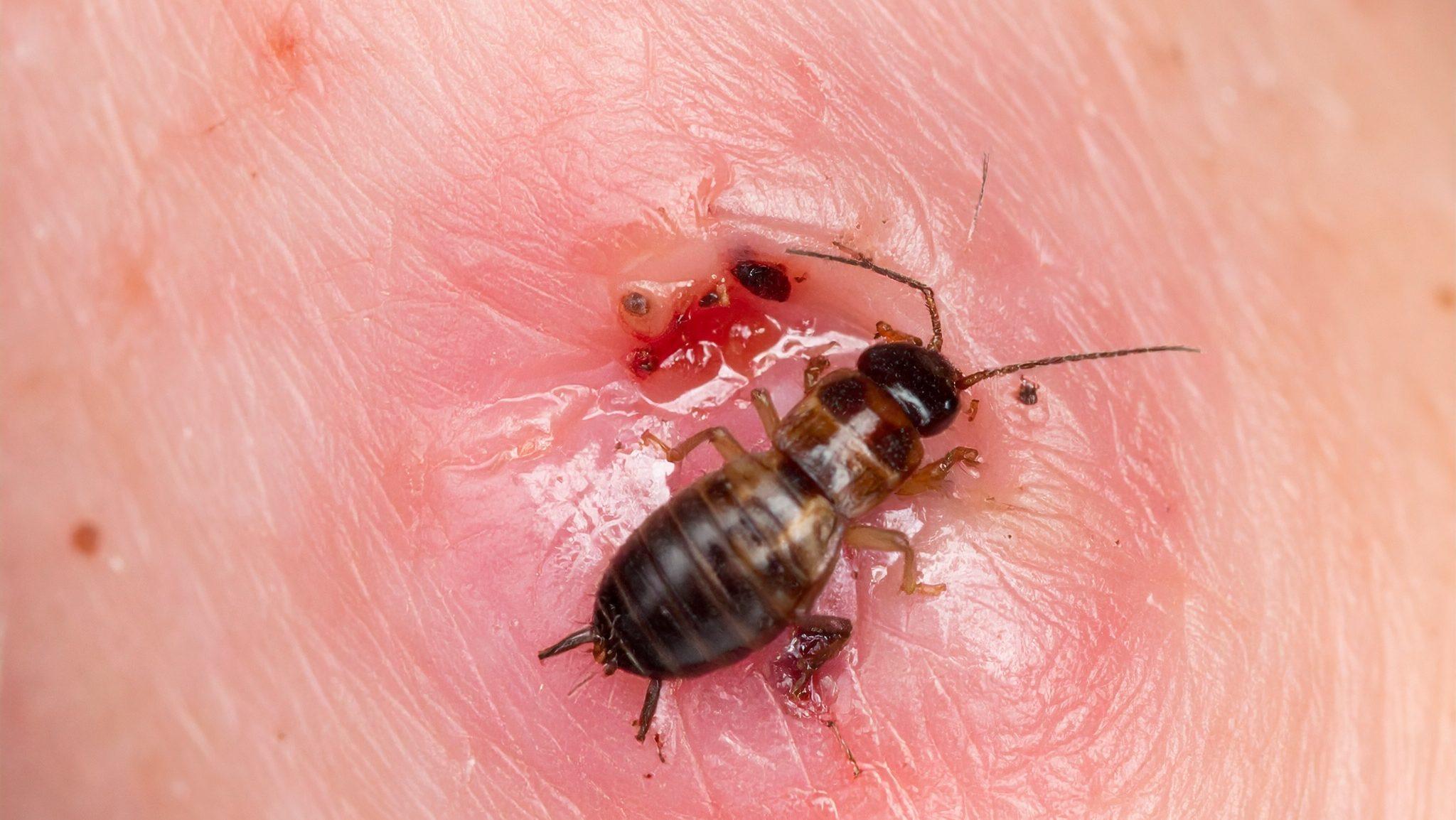 signs of an earwig bite