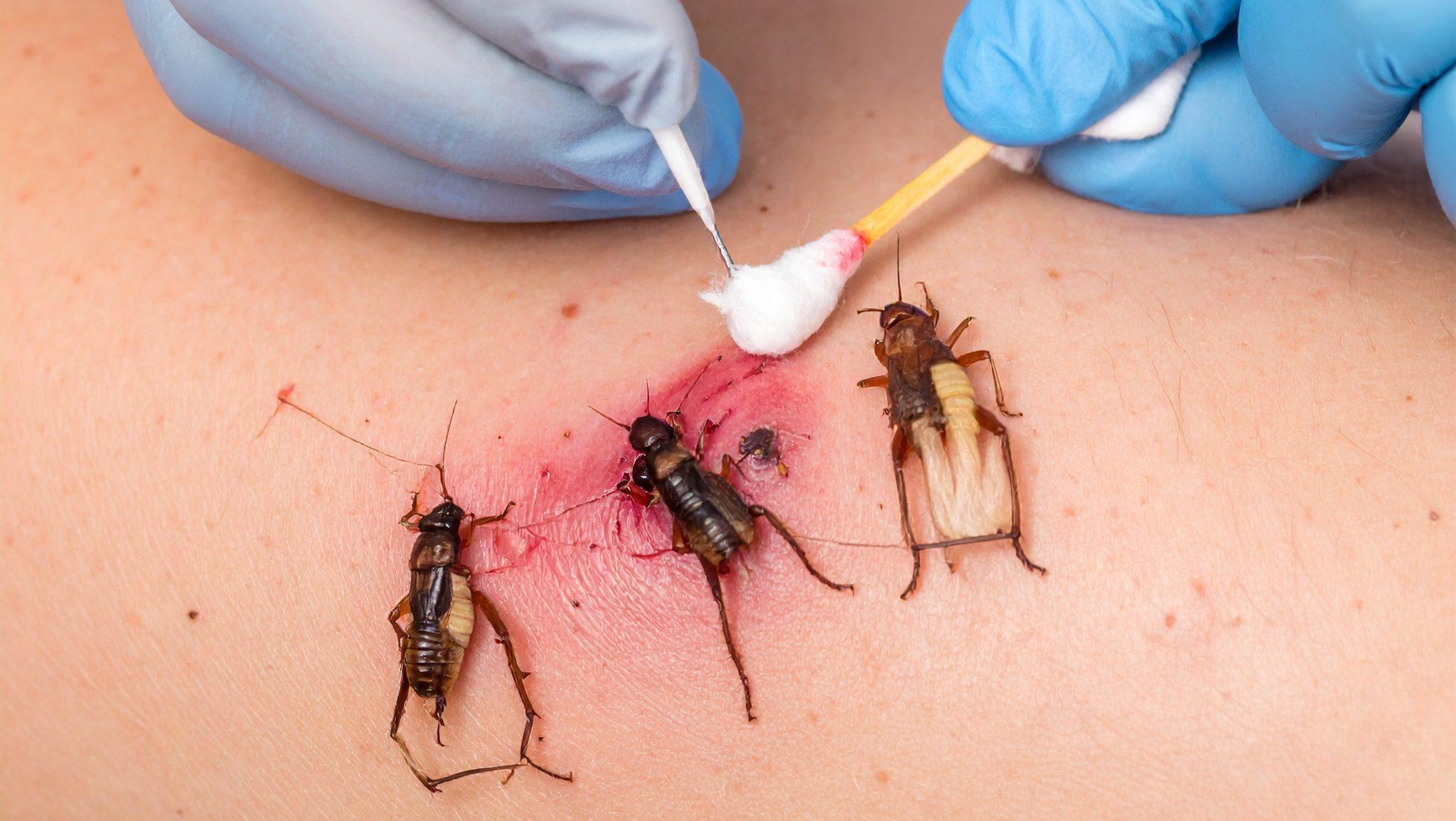 steps to treatment of earwig bite